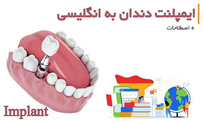 ایمپلنت دندان به انگلیسی